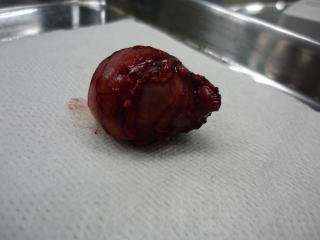 副腎腫瘍(腺腫)