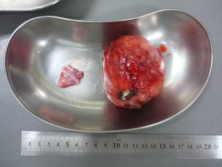 混合悪性腫瘍